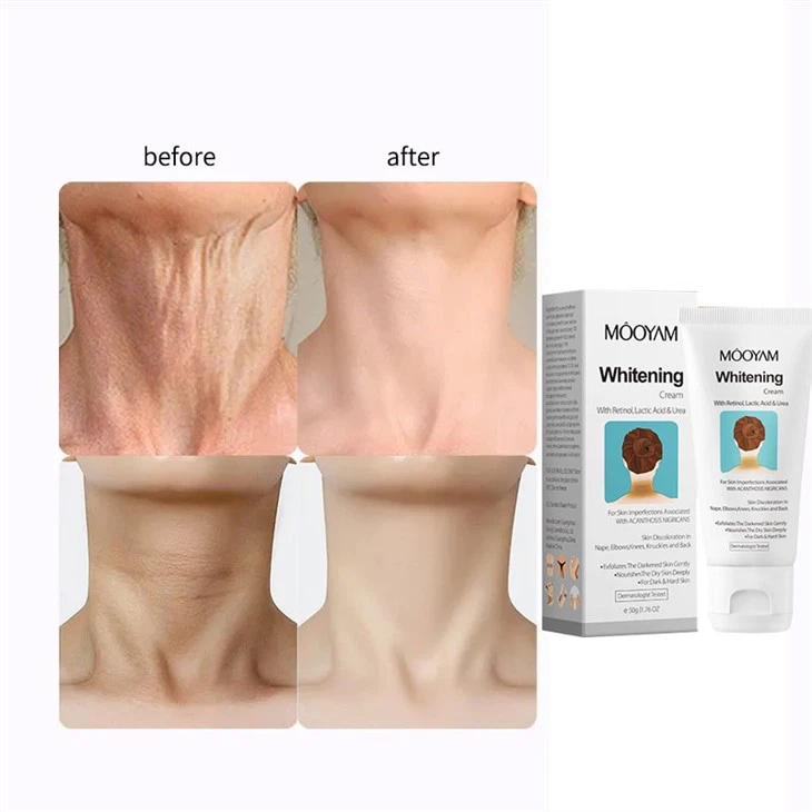 acanthosis-nigricans-therapy-creamf5218e80-c00f-4b6b-b215-a808844b091a.jpg